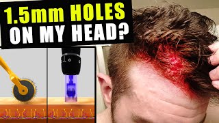 I Cut Thousands Of 15 Millimetre Holes In My Head Every Week To Prevent Hair Loss [upl. by Eniamrej506]