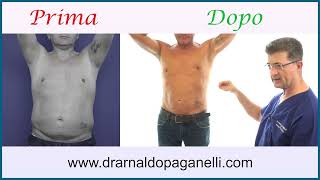 Caso studio liposcultura con ginecomastia 1 [upl. by Anifares]