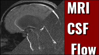 MRI Cerebrospinal Fluid TechniqueCSF Flow [upl. by Skipton933]