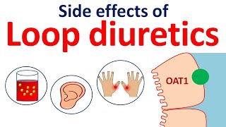 Loop diuretics side effects in easy way  Furosemide bumetanide torsemide [upl. by Anitsyrc]