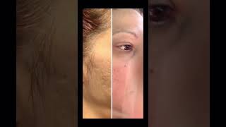 Acne scars gone Profractional laser  acnescartreatment acnescars acnescarremoval acneremoval [upl. by Elumas14]