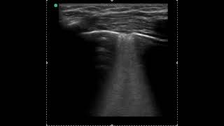 Video 5 Subpleural Consolidation [upl. by Berte]