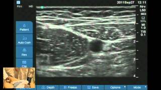 Ultrasound guided obturator and saphenous nerve block workshop [upl. by Ylus]