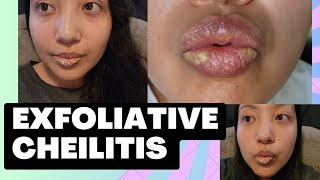 Exfoliative Cheilitis  Ointments amp Creams  Short Chitchat [upl. by Icaj678]