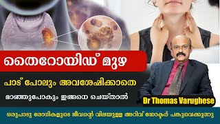 തൈറോയിഡ് മുഴ പാട് പോലും അവശേഷിക്കാതെ മാഞ്ഞുപോകും ഇങ്ങനെ ചെയ്താൽ  Thyroid Dr Thomas Varughese [upl. by Asilec]