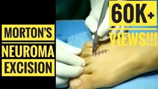 Mortons Neuroma Excision HD Detailed Surgical Video [upl. by Rednaskela254]