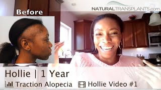 Hair Loss Treatment for Women Result  Traction Alopecia Hair Loss Treatment Result Hollie [upl. by Dnaltiak]