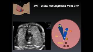 Three Vessel Tracheal View A Review of Normal and Abnormal Findings [upl. by Lorilee946]