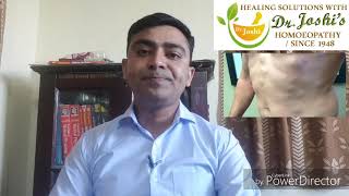 Lipoma Homeopathic Medicine For lipoma [upl. by Shira]