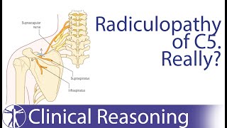 Suprascapular Nerve Entrapment mimicking C5 Radiculopathy [upl. by Buller]