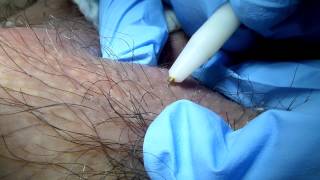 Hair Removal on Terminal Hair Electrolysis [upl. by Repsac]