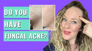 Malassezia Folliculitis  DO YOU HAVE FUNGAL ACNE FUNGAL ACNE SIGNS amp TREATMENT [upl. by Witha463]