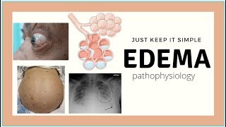 Edema Pathophysiology  Pulmonary edema Ascites physiology basics Med Madness [upl. by Lazos216]