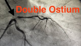 Double Ostium of Left Coronary Artery Proximal Lesion of LAD How To Position the Stent [upl. by Ermengarde]