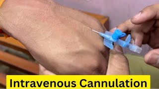 Cannula lgany ka Tareqa  Cannulation technique  iv line procedure Burnula method [upl. by Ehrenberg]