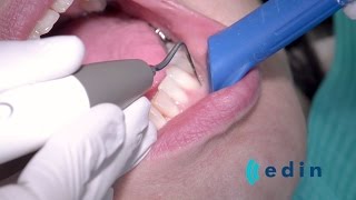 Ultrasoon reinigen bij parodontitis  Edin Dental Academy [upl. by Onateyac960]