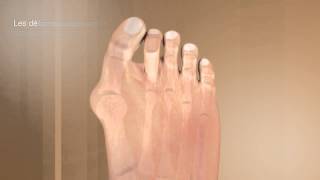 La correction de lhallux valgus et de ses complicationsDr Coillard  Dr Boublil  Dr Grisard [upl. by Rehtaef872]