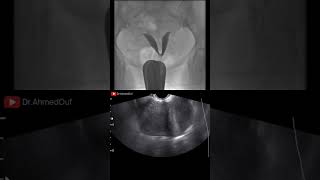 Bicornuate or Septate Uterus radiology ultrasound [upl. by Otsirc]