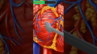 procédure Sneurysm Heart🫀shorts videomedical [upl. by Irec]