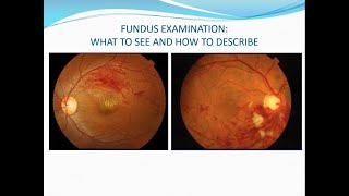 Fundus examination Volk lens direct ophthalmoscopy and binocular indirect ophthalmoscopy [upl. by Elery]