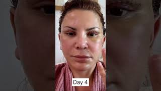 Facelift Patients 3 Week Healing amp Recovery Process [upl. by Adnaram]