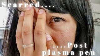 7 weeks post Plasma Pen Treatment Regrets [upl. by Aneehsram]