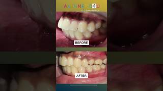 Teeth Straightening with Clear Aligners Treatment in Hyderabad  Braces  Invisible Aligners  Smile [upl. by Secnarf]