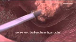 HNO 017 NasenPolypen Entfernung  PAL 169 HNO 017 Removal of nasal polyps  PAL 169 [upl. by Sanfred]