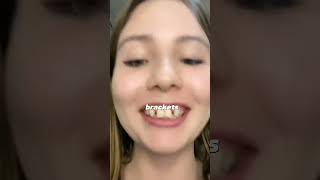 Agenesia dental dientes dentista tips parati viral fyp shorts shortvideo fypシ [upl. by Notla]