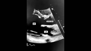 SteroidResponsive Severe Pneumonia PostCOVID19 in a Patient with PANDAS A Case Study [upl. by Arbmahs]