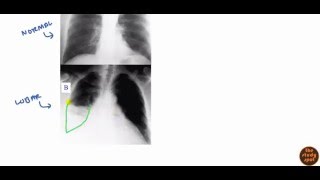 Community Acquired Pneumonia for USMLE Step 2 [upl. by Brynna]