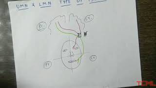 Upper and lower motor neuron type of facial palsy [upl. by Bartram]