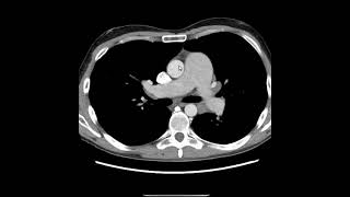 Hipertensão pulmonar [upl. by Nekciv]