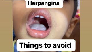 Hand foot and mouth disease  HERPANGINA most important thing to avoid [upl. by Hako]