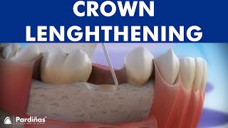 Dental crown lengthening © [upl. by Millburn]