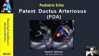 Pediatric Echo  Patent Ductus Arteriosus PDA [upl. by Ettezzil]