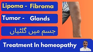 lipoma Fibroma Tumor Glands جسم میں گلٹیاں treatment in homeopathy Dr usman ghani [upl. by Ahsatak]