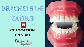 Colocación de brackets de Zafiro EN VIVO [upl. by Mahtal]