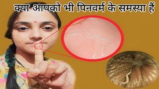 सिर्फ 1 रात मे Pinworms होगा खत्म  How to get rid of Pinworms  Threadworms treatment at home [upl. by Atteroc342]