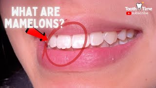 What are mamelons do you need to fix them Tooth Time Family Dentistry New Braunfels [upl. by Wilmette]