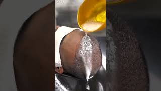 Expert Tips for First Shampoo After Hair Transplant  Cara Clinic [upl. by Belanger]