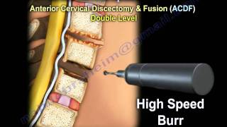 Cervical Spine Decompression And Fusion   Everything You Need To Know  Dr Nabil Ebraheim [upl. by Nob894]