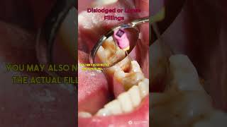 Dislodged or Loose Fillings dentist filling [upl. by Cattima]