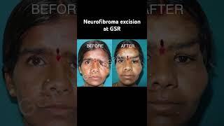 Neurofibroma Surgery at GSR [upl. by Morgana]