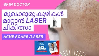 acne scars laser treatment malayalammalayalam acnescars acnetreatment laser [upl. by Stroud408]