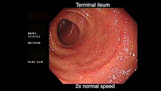 DEEP BACKWASH ILEITIS AND ULCERATIVE COLITIS [upl. by Christiansen]