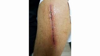 Can I Use Mupirocin Ointment On An Open Wound [upl. by Way]