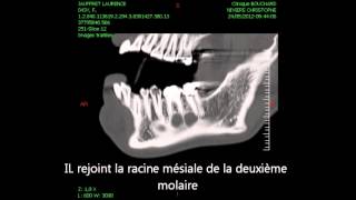 Concept actuel de la préservation de lalvéole lors de lextraction dentaire [upl. by Dnalor]