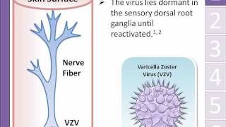 Shingles herpes zoster Animation  Michael Freudiger [upl. by Leandra]