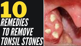 How To Remove Tonsil Stones Naturally 10 Home Remedies That Work [upl. by Ocirnor548]